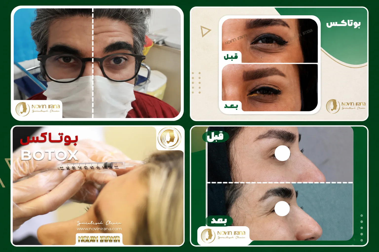 قبل و بعد تزریق بوتاکس مشهد